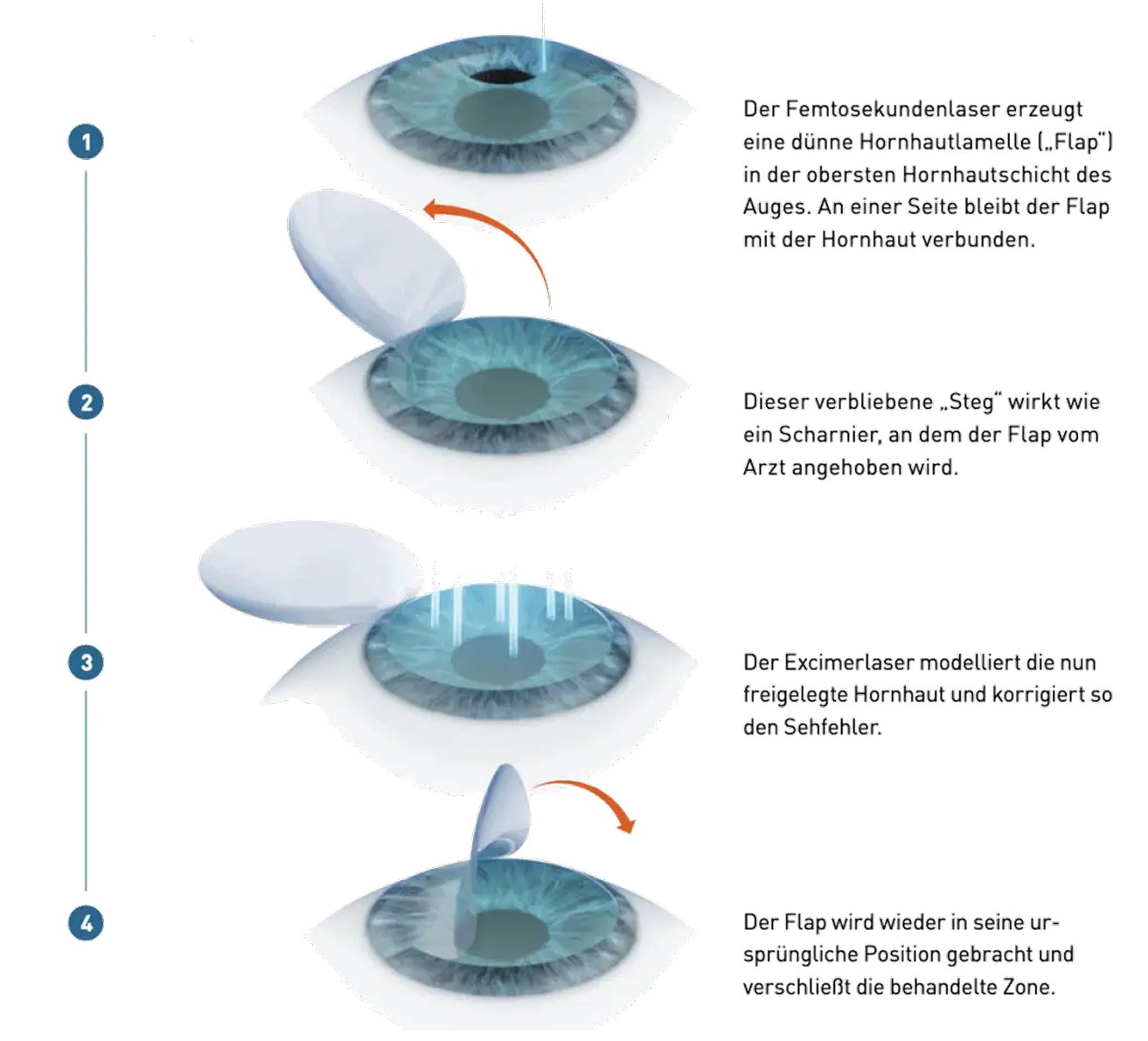 Ablauf SmartSight Schritt für Schritt